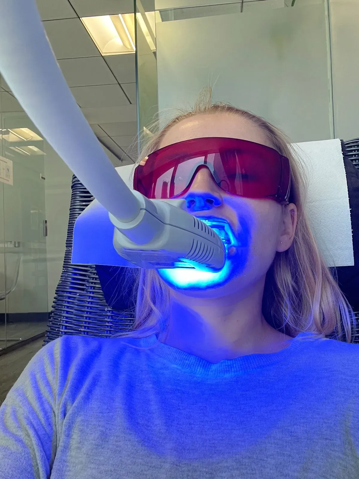Zoom! teeth whitening before and after results — Huntington Beach patient, Dr. Richard Baldwin DMD