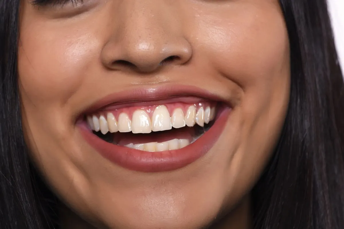 Lumineers by Cerinate at HB Dentist Huntington Beach
