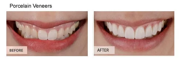 Porcelain Veneers Cost and Benefits: Is It Worth It?
