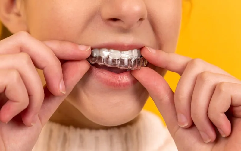 Dentist placing a precisely fitted ceramic crown onto a prepared tooth