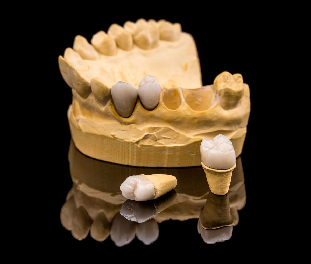 Porcelain dental crown designed to match natural tooth color and shape