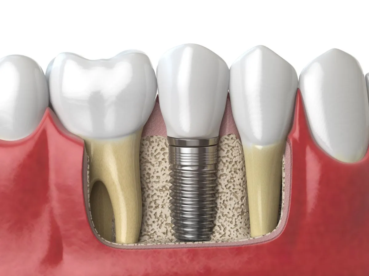 Patient consulting with dentist about dental implant treatment options