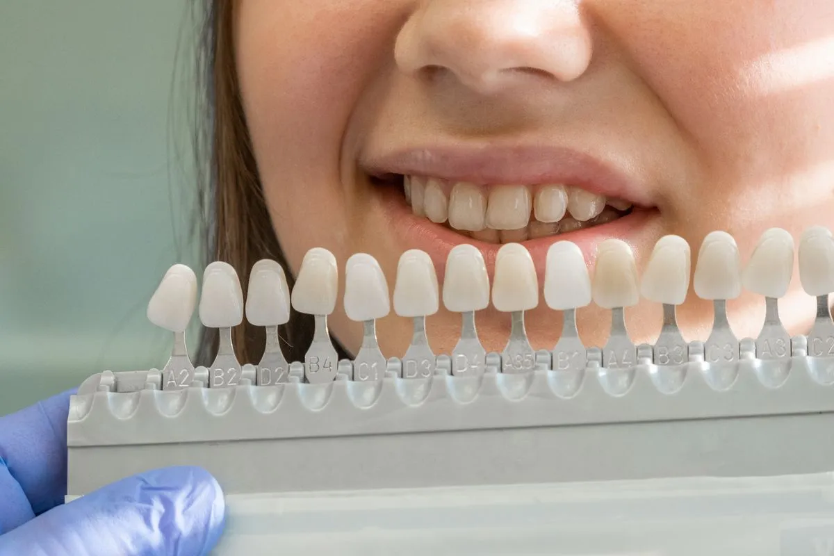 Ultra-thin Lumineers veneers creating a naturally beautiful smile transformation