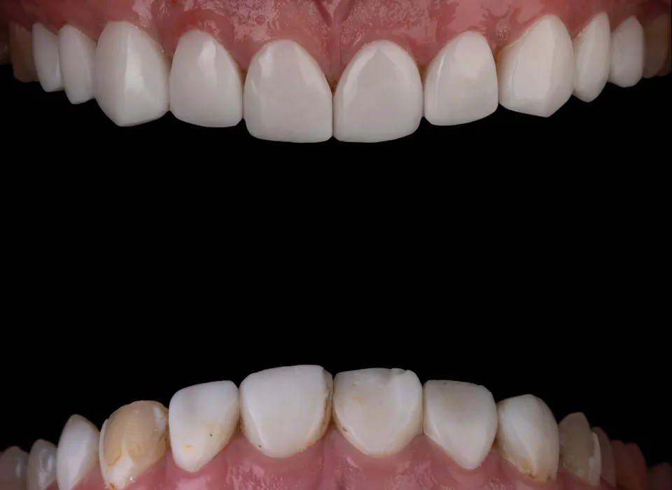 What Causes Cavities and How to Prevent Them: A Complete Guide