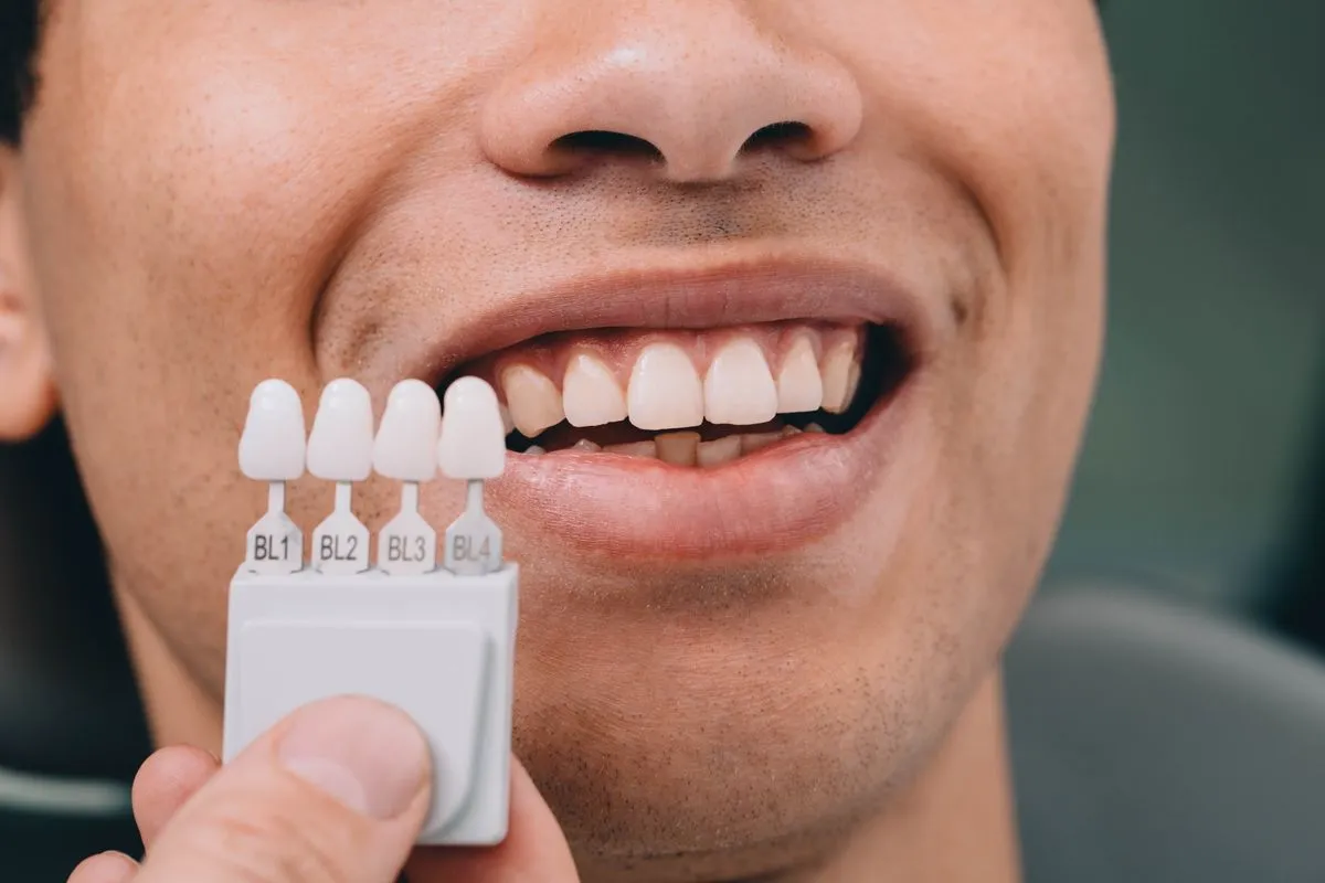 Veneers & Laminates at HB Dentist Huntington Beach