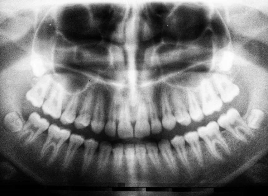 Wisdom Teeth Removal: Complete Guide for Huntington Beach Patients