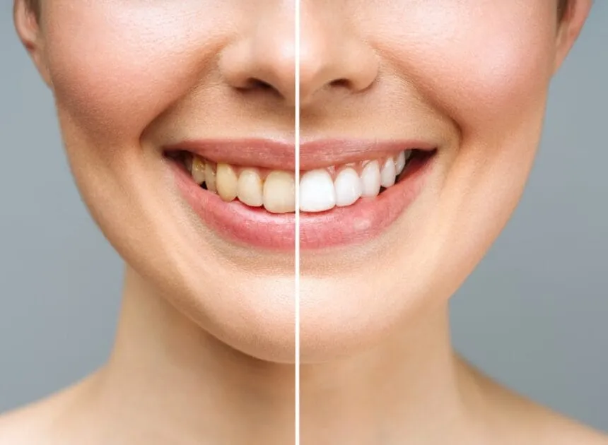 Teeth Whitening Options in Huntington Beach: Zoom vs Take-Home Kits